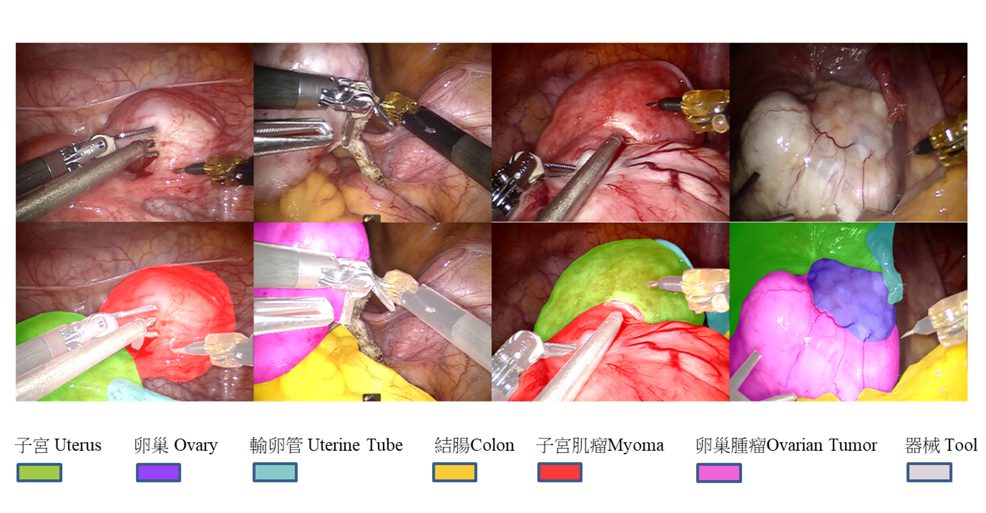 團隊自主開發「器官圖像分割系統(DeepVinci)」，在手術進行中即時辨識，並以色塊方式清楚標記子宮、卵巢、輸卵管、結腸及腫瘤等組織，協助醫師在解剖與切除過程中掌握器官或腫瘤邊界，有助於降低手術誤傷風險。