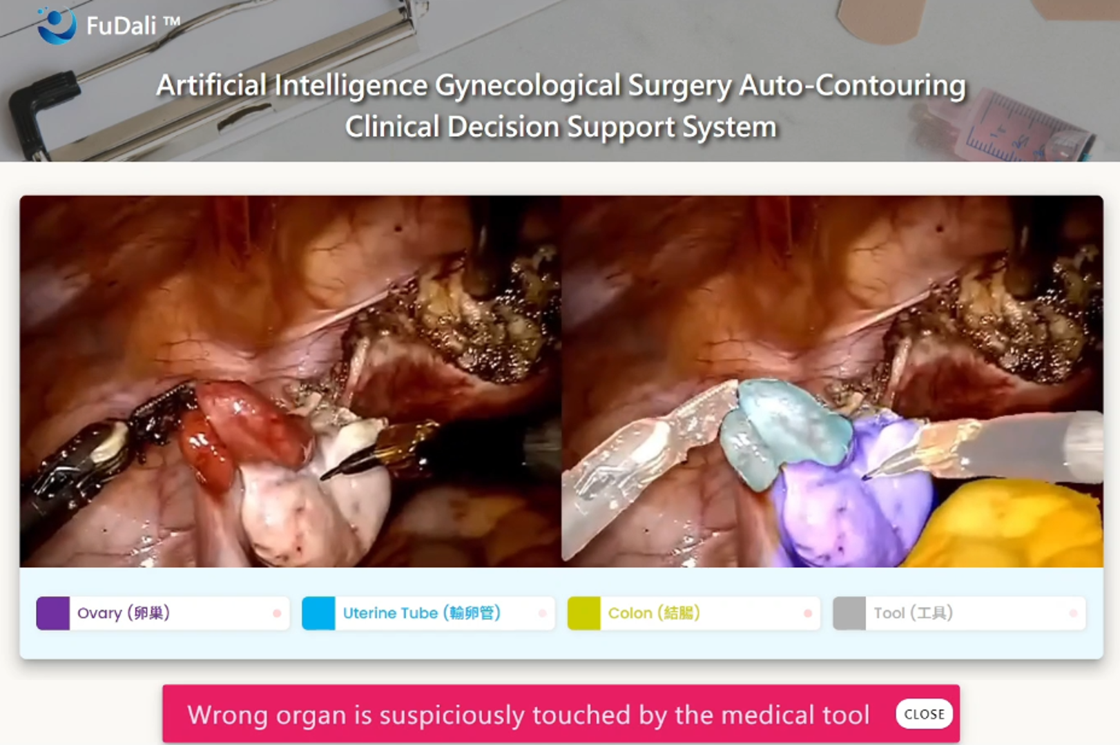 研究團隊將婦科手術畫面導入平台，系統會即時辨識重要組織，當手術器械靠近重要器官時也會跳出警示。